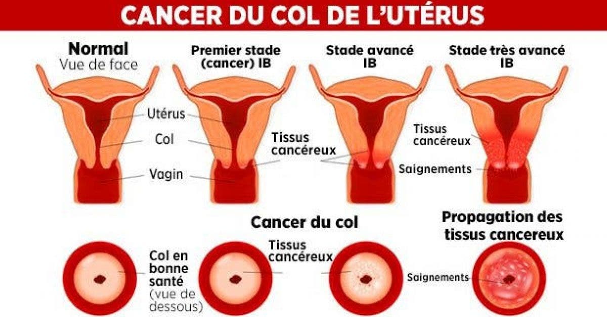 cancer col de luterus 2 1