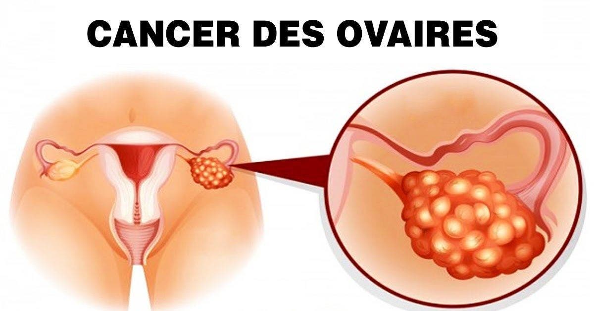 13 signes que le cancer de l’ovaire se développe dans votre corps