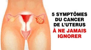 cancer de l'uterus