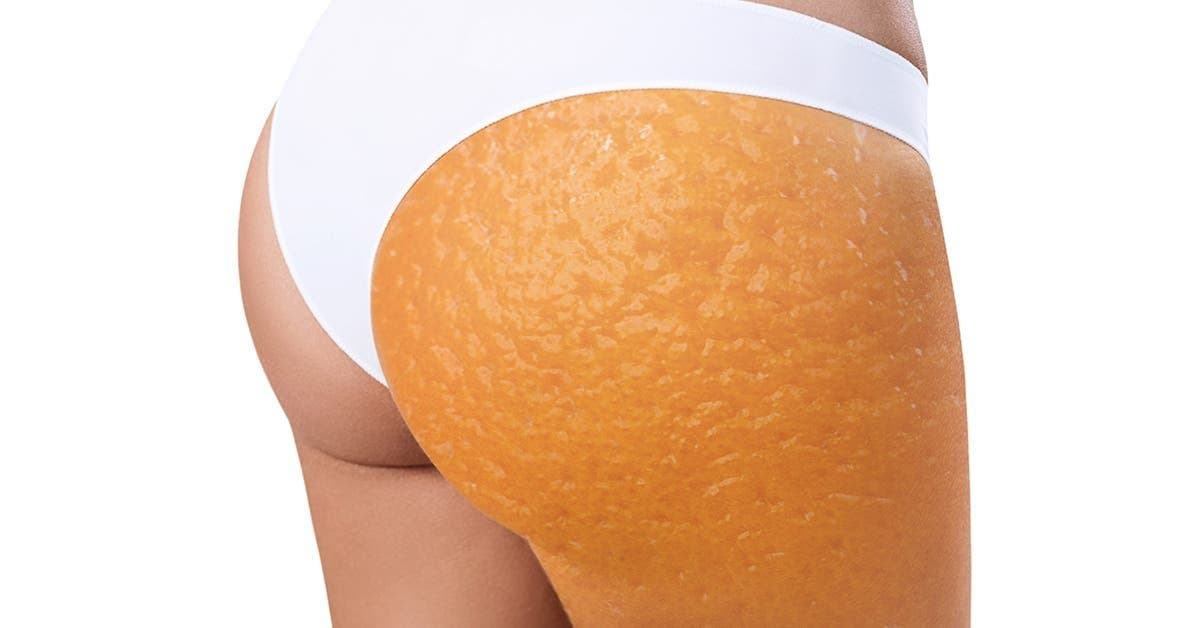 Voici comment vous devez utiliser le citron pour éliminer les vergetures blanches sur les fesses