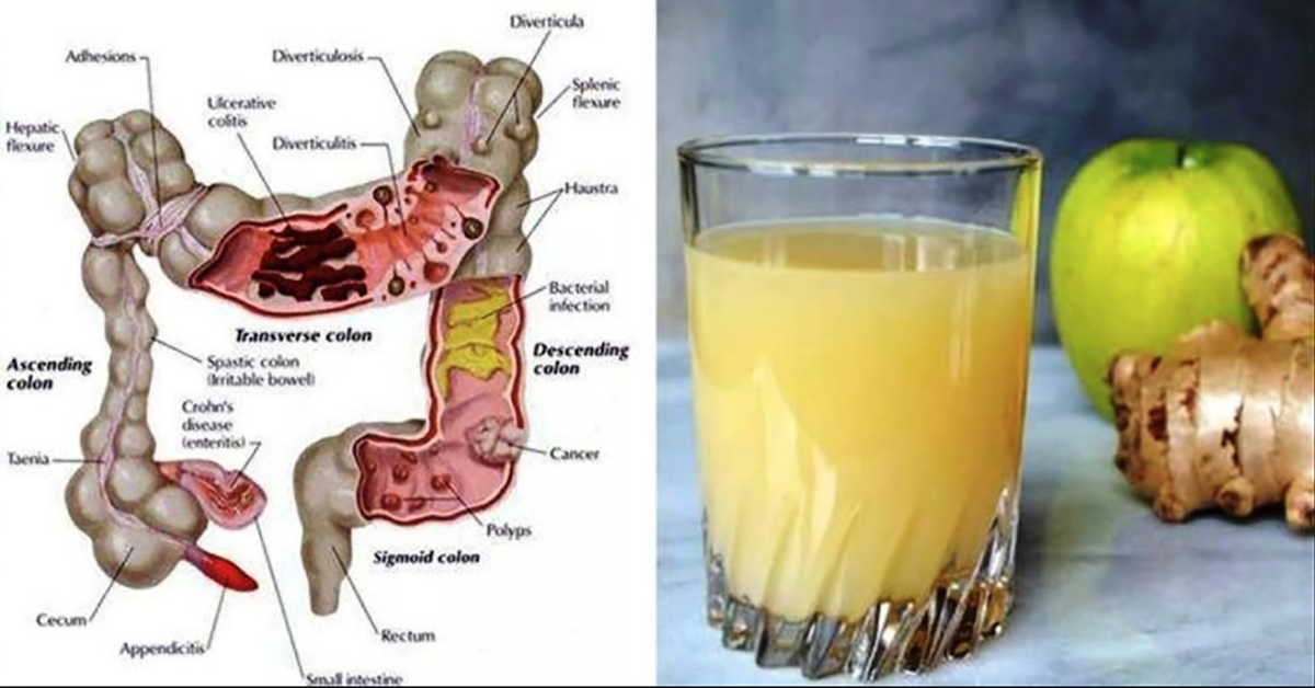 cette delicieuse boisson au citron gingembre et pomme peut eliminer jusqua 5 kg de toxines de votre colon 1 1