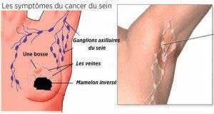 comment prevenir le cancer du sein grace a une detoxification des aisselles 1
