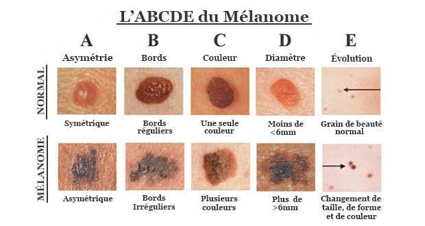Comment reconna tre le cancer de la peau