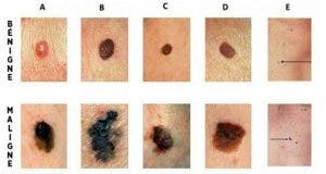 comment reconnaitre les signes dun cancer de la peau un geste qui peut vous sauver la vie 1