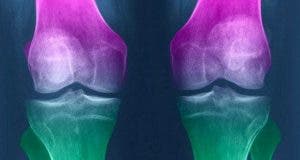 comment regenerer le cartilage du genou naturellement 1