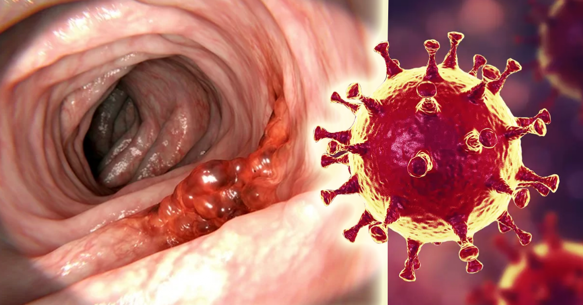 des-chercheurs-creent-un-virus-capable-de-tuer-le-cancer-du-colon
