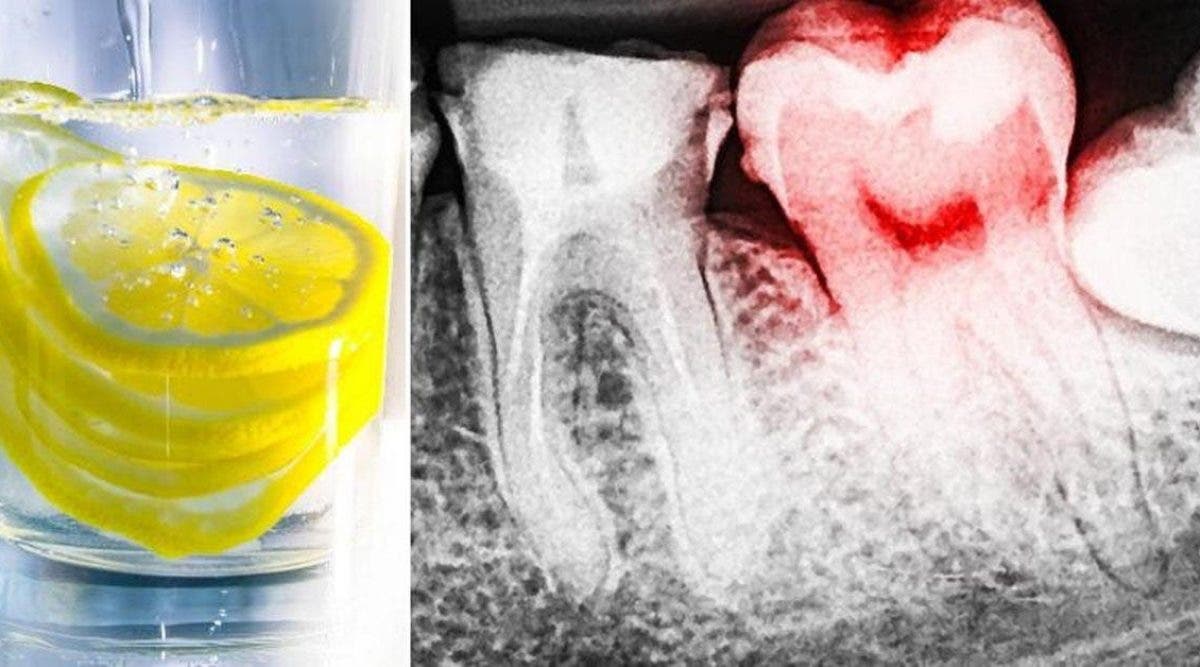 L’eau au citron peut détruire vos dents