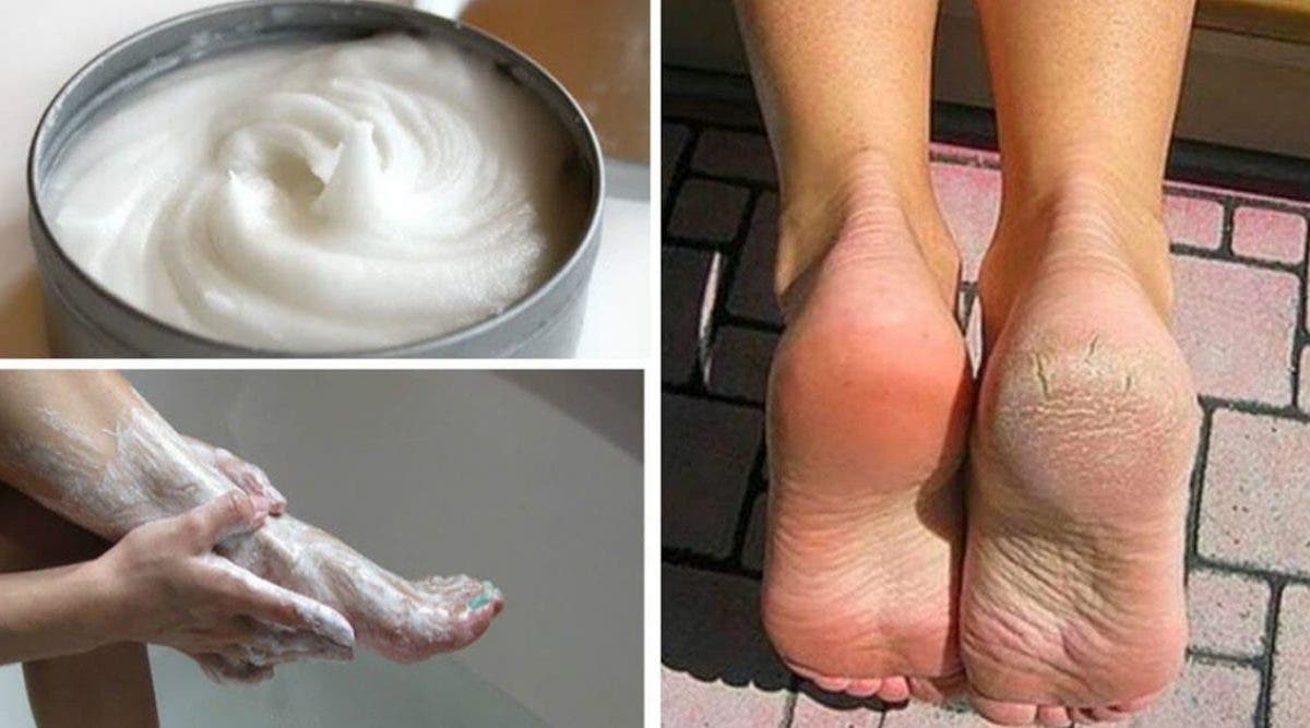 Éliminez toutes les callosités et les cors des pieds avec ce remède maison au bicarbonate