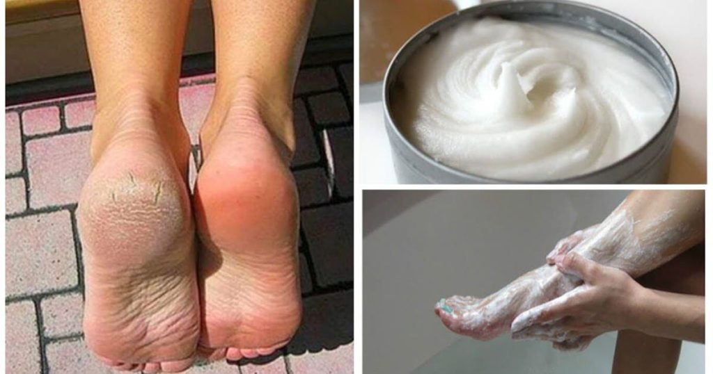 7 recettes pour traiter les pieds secs avec du bicarbonate de soude