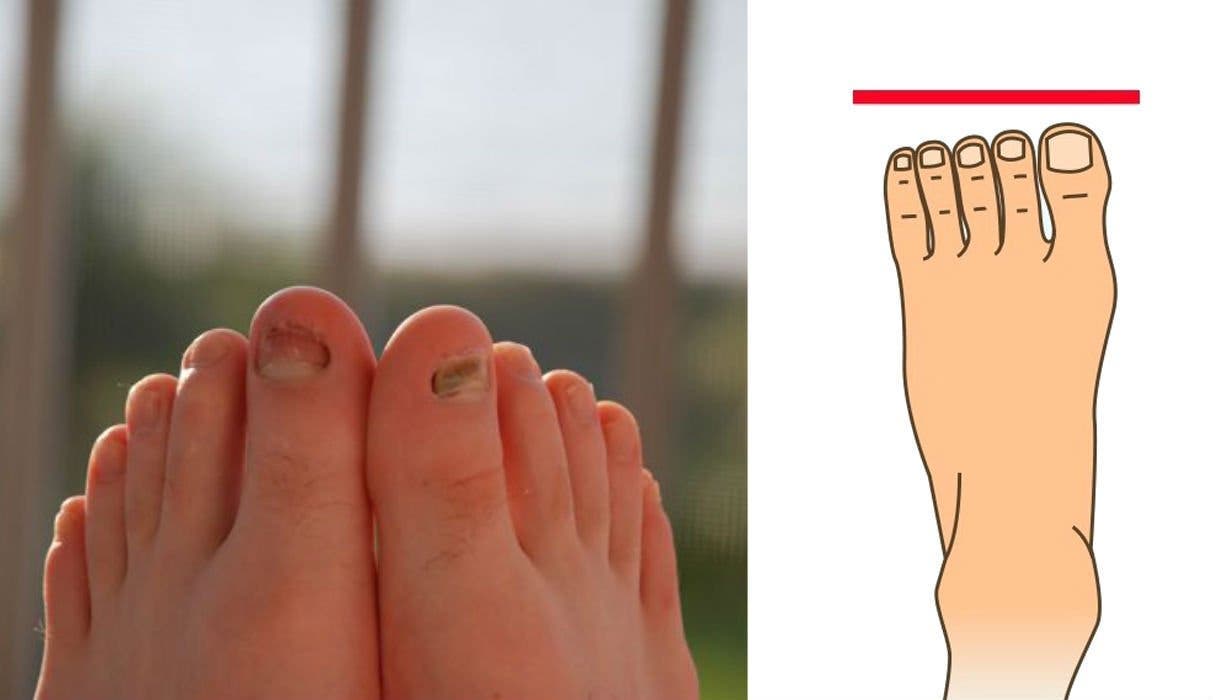 formes de pieds