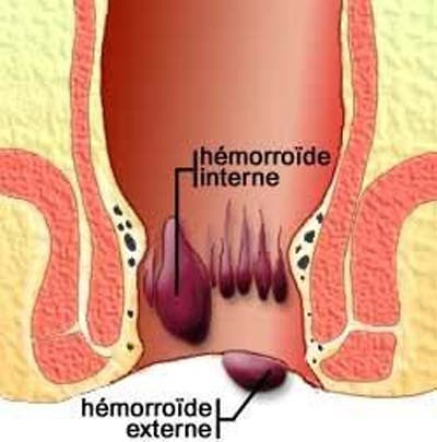 hemoroides