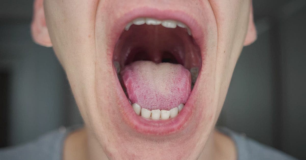 la--langue-covid--symptome-du-coronavirus