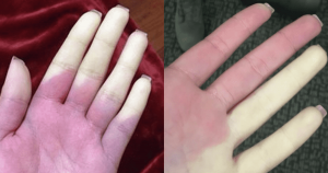 la-maladie-de-raynaud-peut-rendre-vos-doigts-completements-blancs-ou-bleus-des-quil-fait-froid