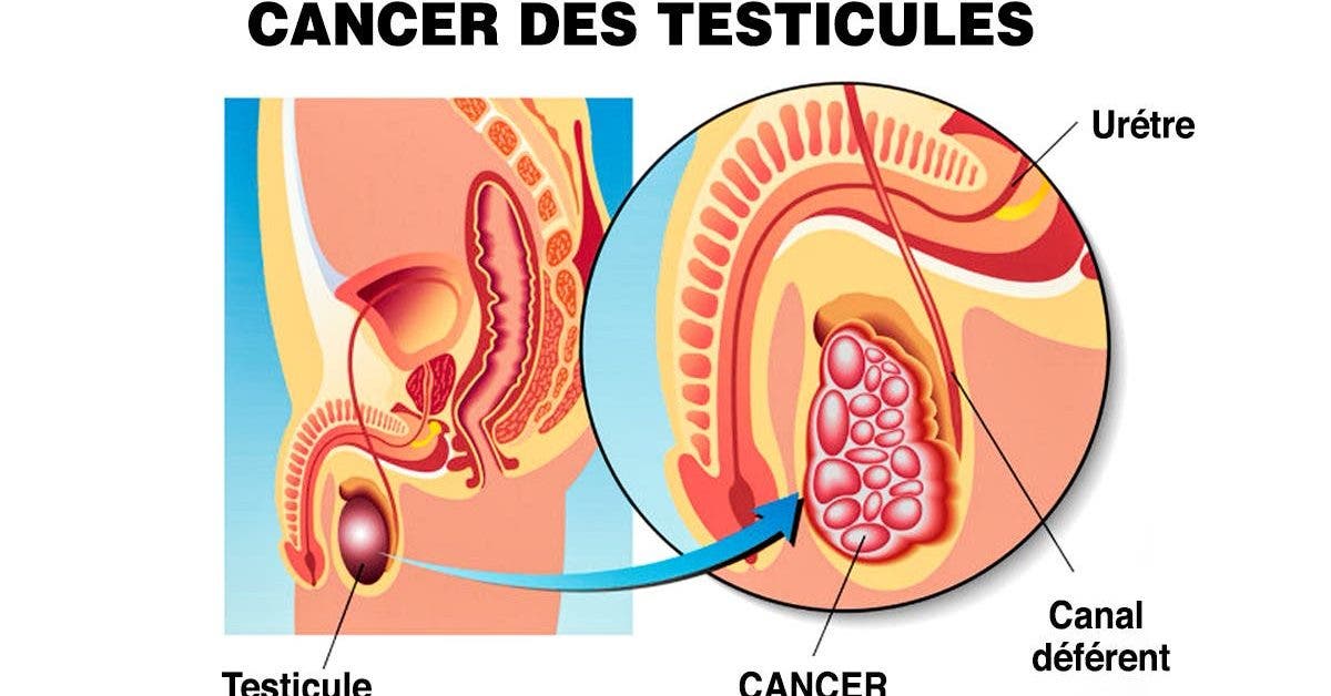 le cancer des testicules quels sont les symptomes et les causes de cette maladie 1