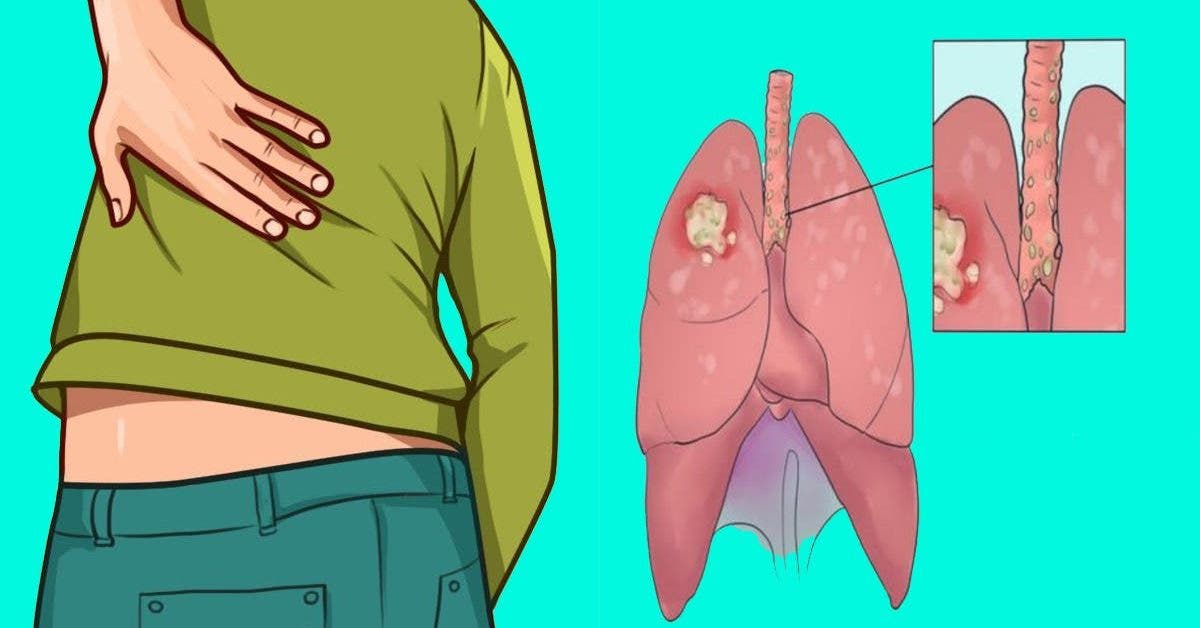le-cancer-du-poumon-tue-chaque-annee-plus-de-30-000-personnes-en-france-11-symptomes-a-identifier