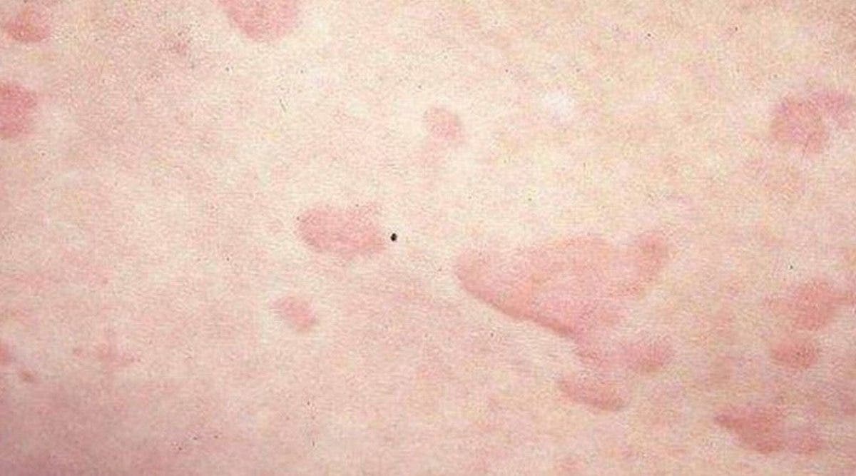 le-coronavirus-est-un-tueur-silencieux-les-eruptions-cutanees-peuvent-etre-un-symptome-dapres-les-dermatologues