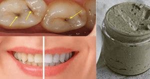 le dentifrice fait maison qui blanchit les dents soigne les caries et les maladies des gencives 1