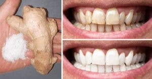 le gingembre et le sel permettent de blanchir les dents