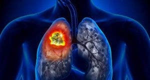 les 7 signes precurseurs dun cancer du poumon 1