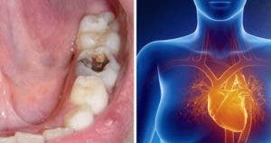les-caries-dentaires-peuvent-causer-une-infection-et-toucher-dautres-organes-du-corps