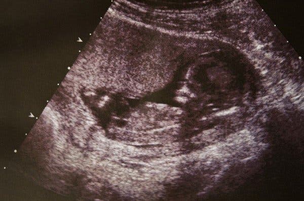 les médecins n’arrivent pas à croire ce qu’ils voient lorsque le bébé est né