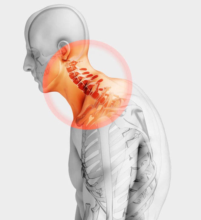 Cervicalgie
