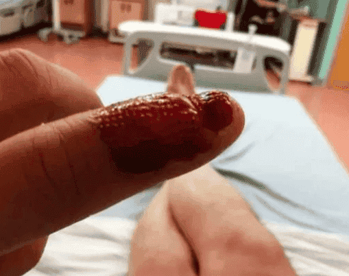 Un homme contracte une infection mortelle après avoir rongé ses ongles