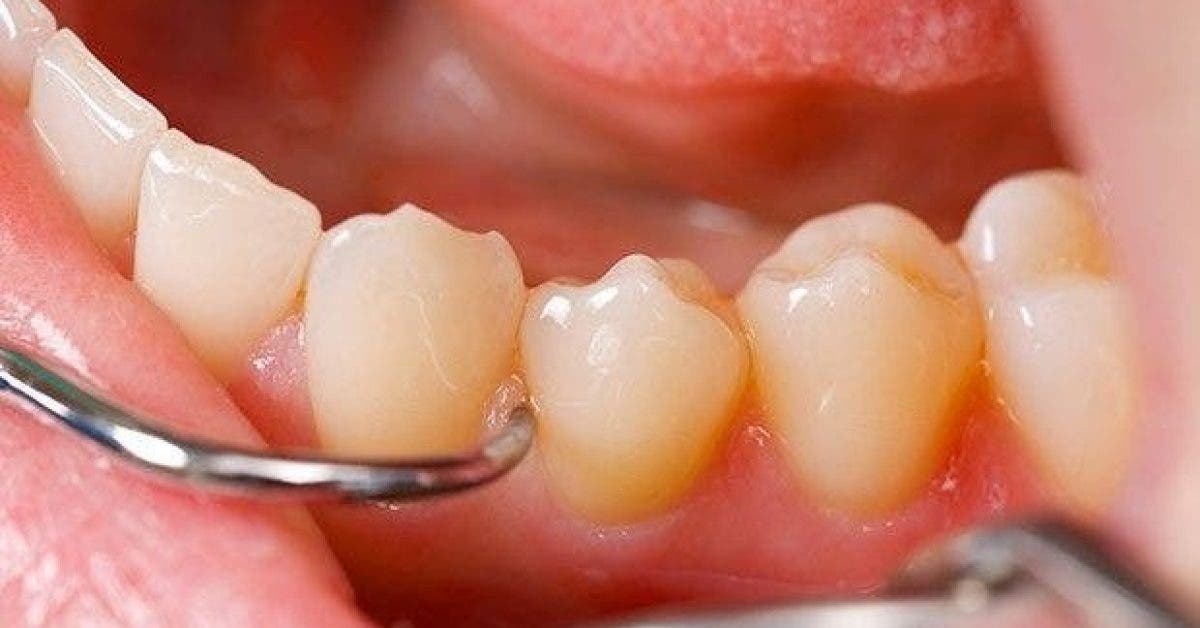 prevenir lerosion dentaire 1