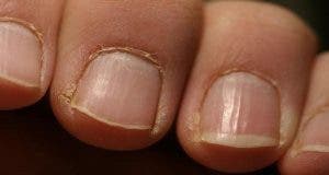 Alerte rouge : si vous voyez cela sur vos ongles consultez immédiatement un médecin !