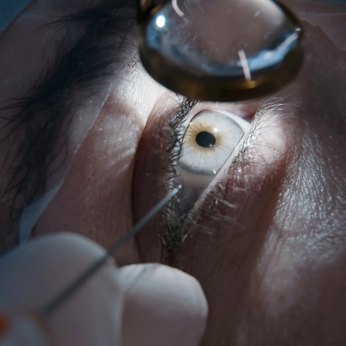 Pose de l’implant monofocal.