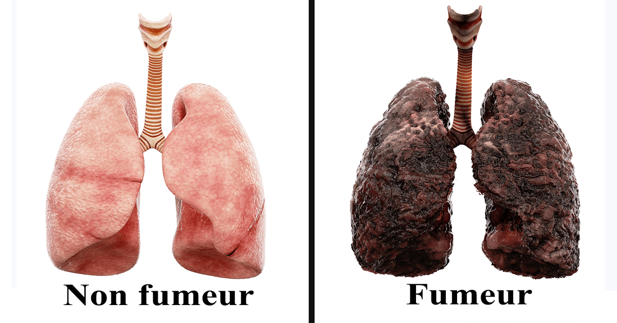 Une infirmière explique ce que le tabagisme fait chaque jour à vos poumons