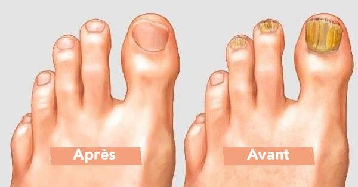 Même les médecins sont étonnés : trempez vos pieds dans ce mélange pour retirer naturellement les champignons de vos orteils
