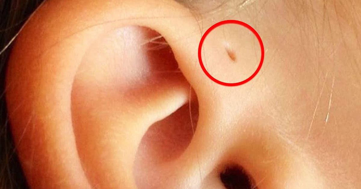 Pourquoi certaines personnes ont des petits trous près des oreilles ?