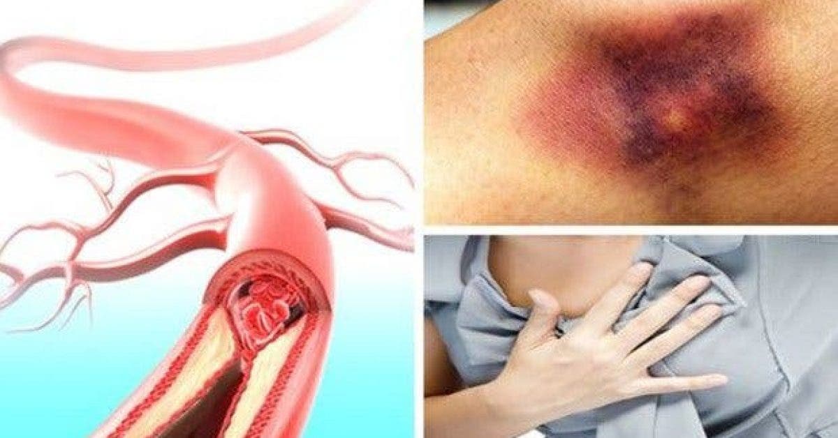 un caillot de sang peut etre fatal voici les signes et les symptomes que vous devez connaitre 1