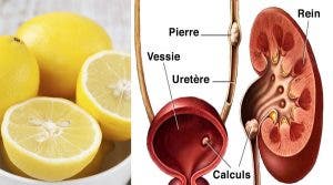 une-ancienne-recette-au-citron-pour-eliminer-les-calculs-renaux