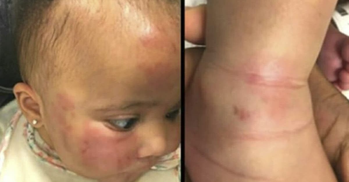 une maman confie son enfant de 6 mois a une creche et realise son erreur lorsquelle decouvre son enfant couvert decchymoses 1
