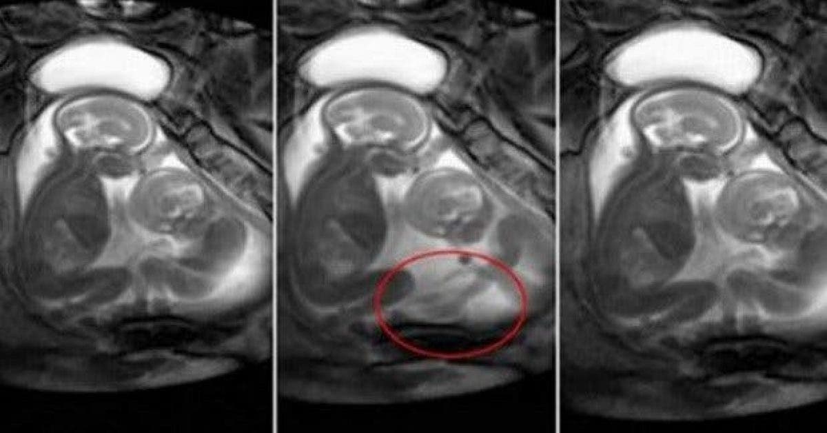 une mere enceinte de jumeaux fait une irm elle narrive pas a croire ce que ses bebes sont en train de faire 1