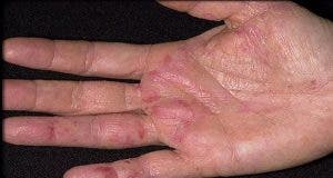 voici comment reconnaitre les premiers symptomes dun cancer apparaissent sur les mains 1