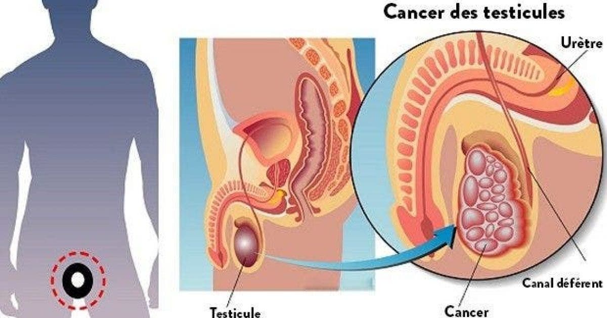 voici comment reconnaitre un cancer du testicule en 3 minutes 1