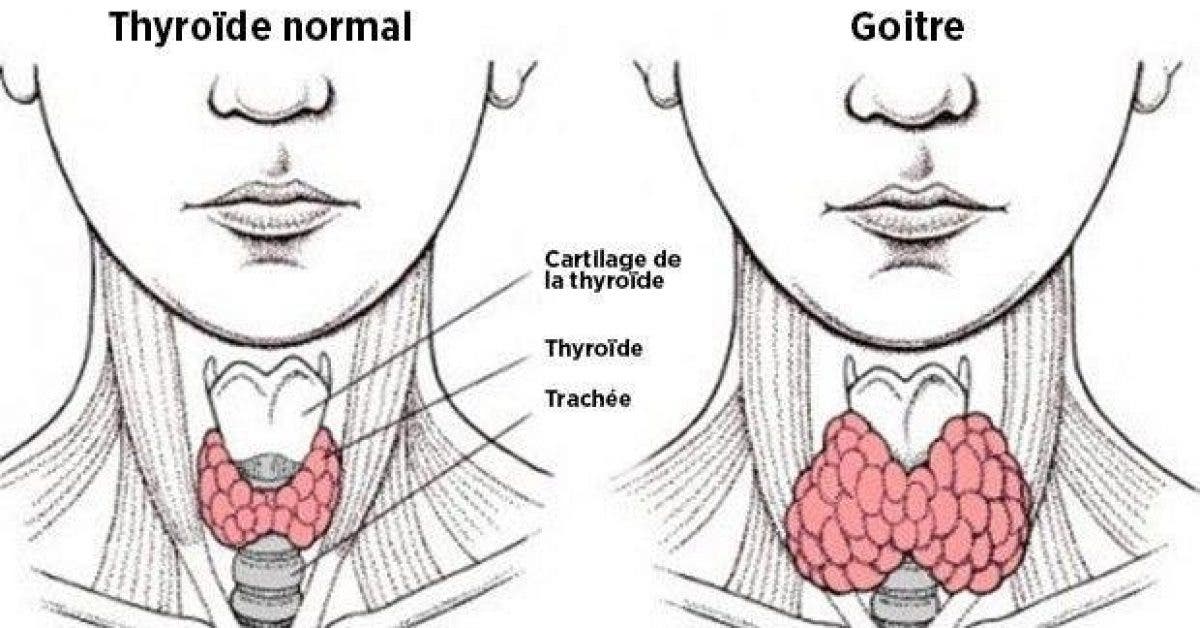 voici comment un mauvais transit intestinal peut provoquer un dereglement de la thyroide et 6 astuces pour y remedier 1