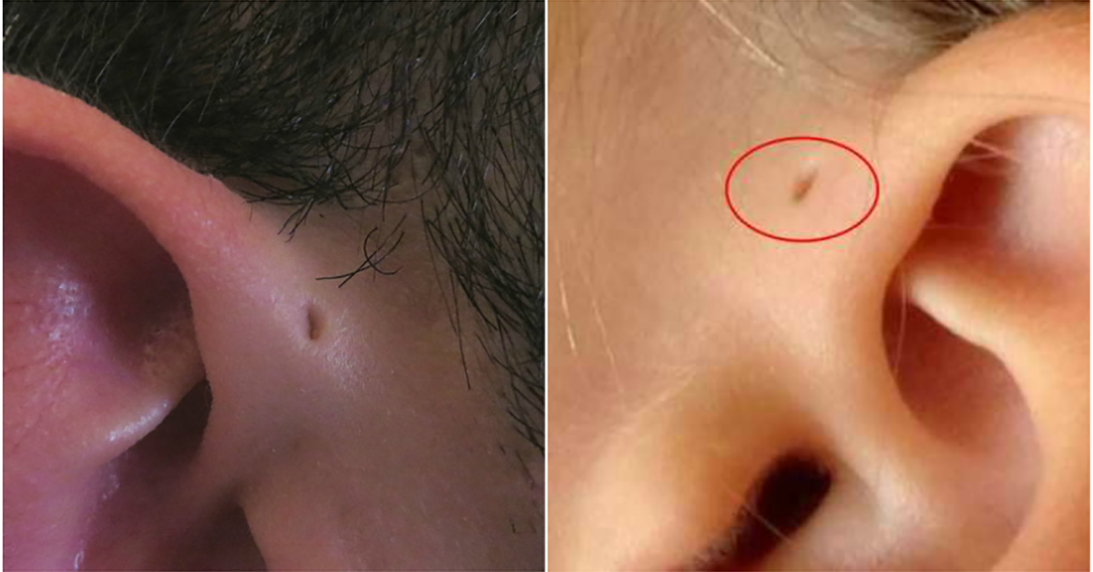 Voici Pourquoi Certaines Personnes Ont Des Petits Trous Pres Des Oreilles