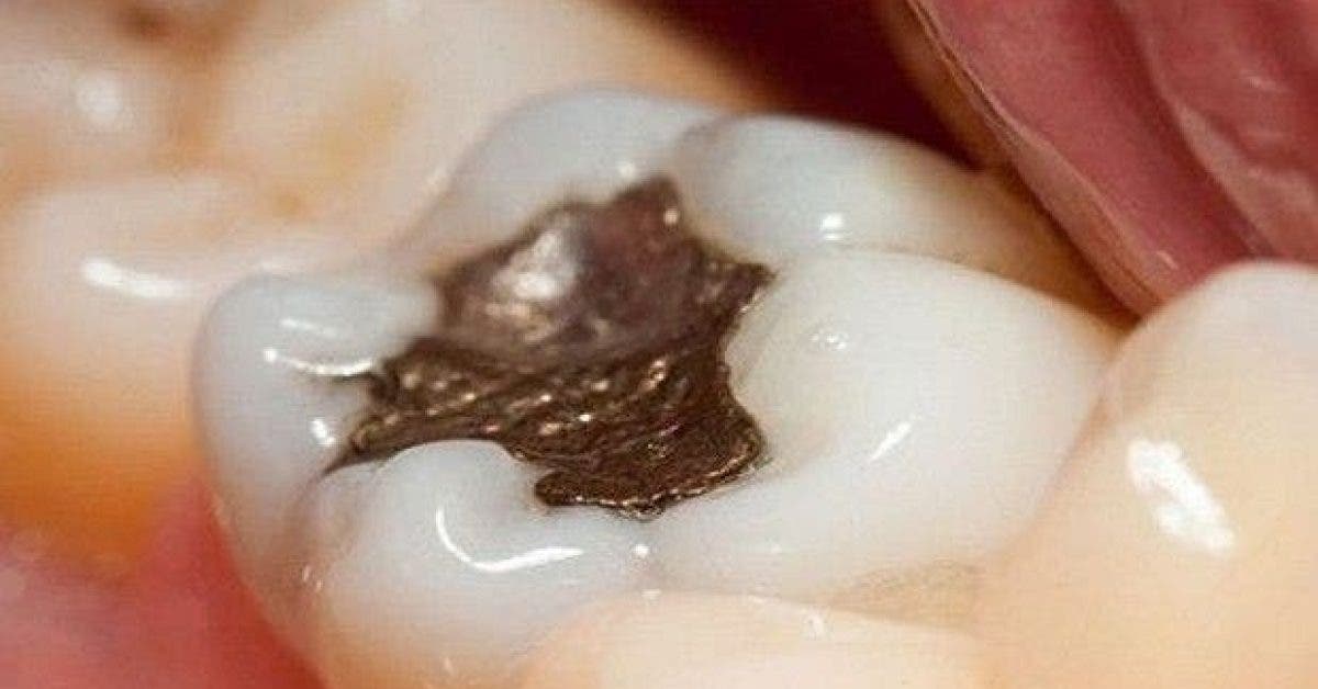voila pourquoi il faut enlever vos amalgames dentaires 1