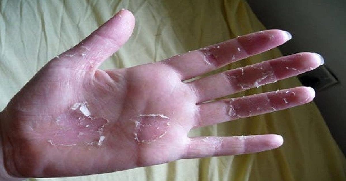 vos mains pelent voici des remedes efficaces pour retrouver une peau de bebe 1